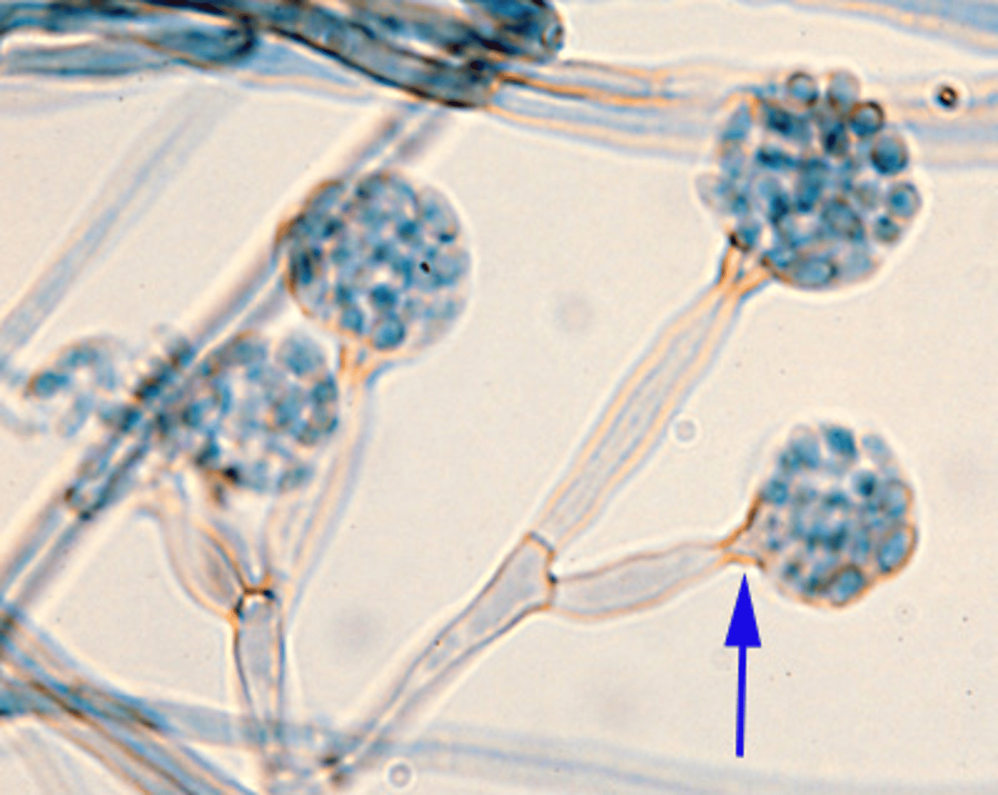 <p>In observing the slow-growing, 7-day-old dark brown colonies growing on Sabouraud Dextrose with Brain Heart Infusion (SABHI) agar, note that the black pigment extends to the reverse of the colony. This provides a presumptive indication of one of the fungi involved in chromoblastomycosis. The species identification of this fungus can be made by observing the distinctive fruiting heads illustrated in the bottom image. Select the identification of the fungal species.</p>