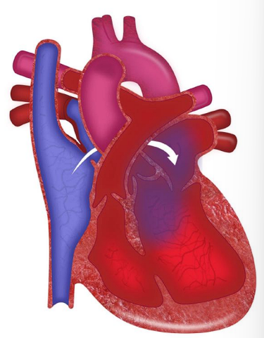 __**● Defect:**__ 

○ Tricuspid valve does not grow  

○ Leaves no communication between the right atrium  and the right ventricle 

○ VSD/ASD 

○ Hypoplastic right ventricle  

○ Enlarged mitral valve and left ventricle  

__**● Specific assessment findings:**__ 

○ Cyanosis  

__**● Treatment**__  

○ Prostaglandins 

○ Surgical repair - BT shunt, Rashkind procedure 