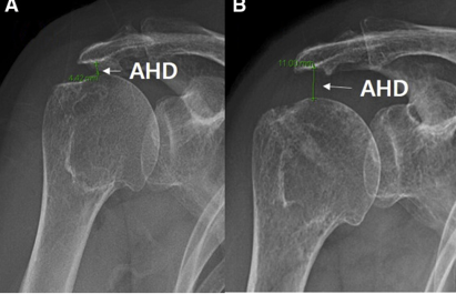 <p>Rotator Cuff Pathologies/Dysfunction on radiograph, what is seen visually?</p>