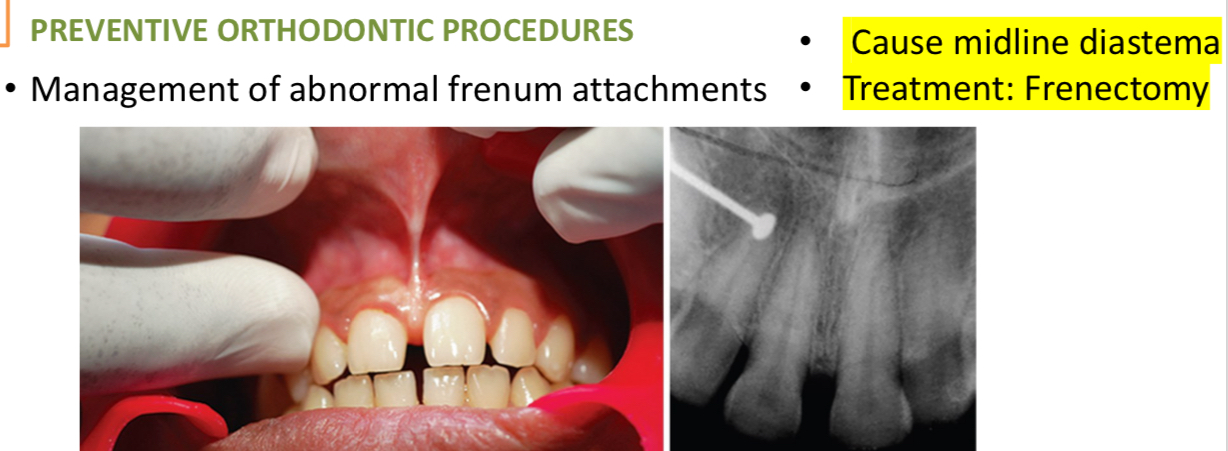 <p>Space maintainers</p><p>Manage ankylosis and prolonged retention of temp teeth</p><p>Extract supernumerary teeth</p><p>Manage oral habits</p><p>Treat premature contacts</p><p>Abnormal frenums- diagnose with blanch test and notch like radiolucency between max ci</p>