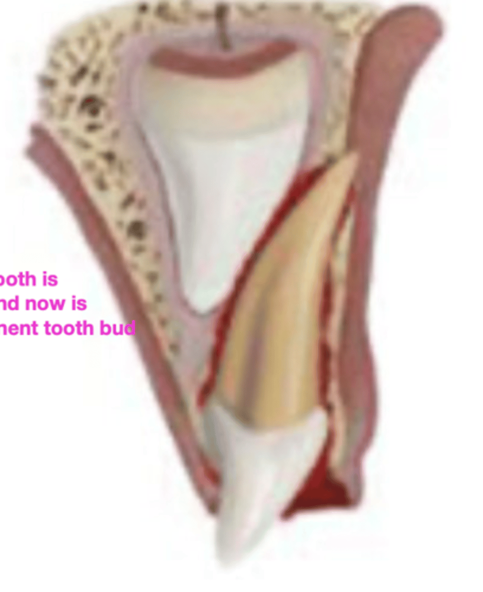 <p>d. Intrusive luxation</p>