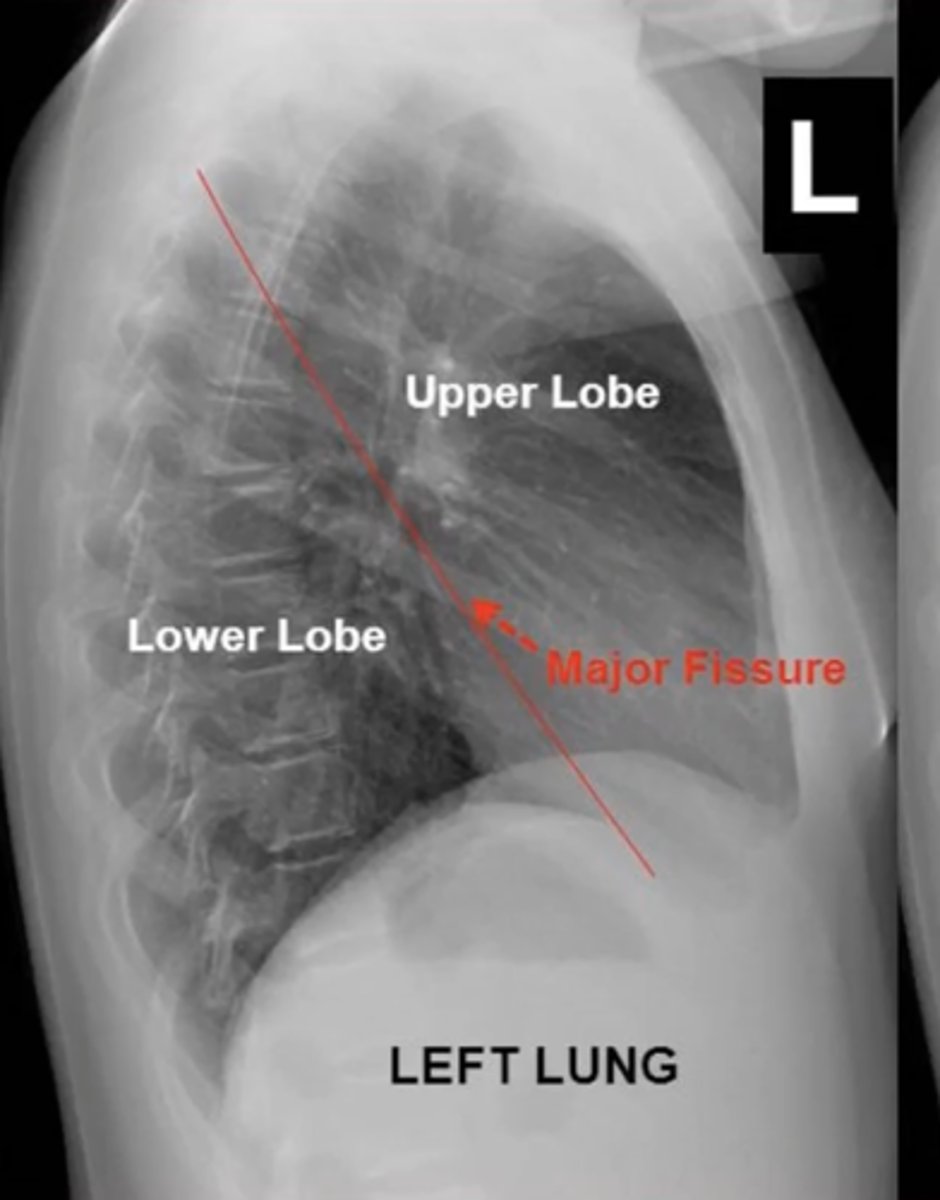 <p>fissure seperates LUL from LLL?</p>