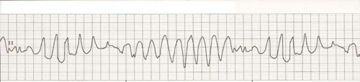 <p>-twisting of the points </p><p>-outline looks like a party streamer </p><p>-P wave absent </p><p>-wide and polymorphic QRS </p><p>-associated with prolonged QT interval (QTc is associated with prolonged ventricular repolarization) </p><p>-caused by HypoCa2+, HypoMg2+, and HypoK+</p><p>-PVC falling during the QTI initiates this </p><p>-long QT syndrome </p><p>-treatment: magnesium </p>