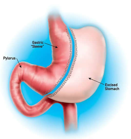 <p>about how much of the stomach is <strong>removed</strong> in sleeve gastrectomy?</p>