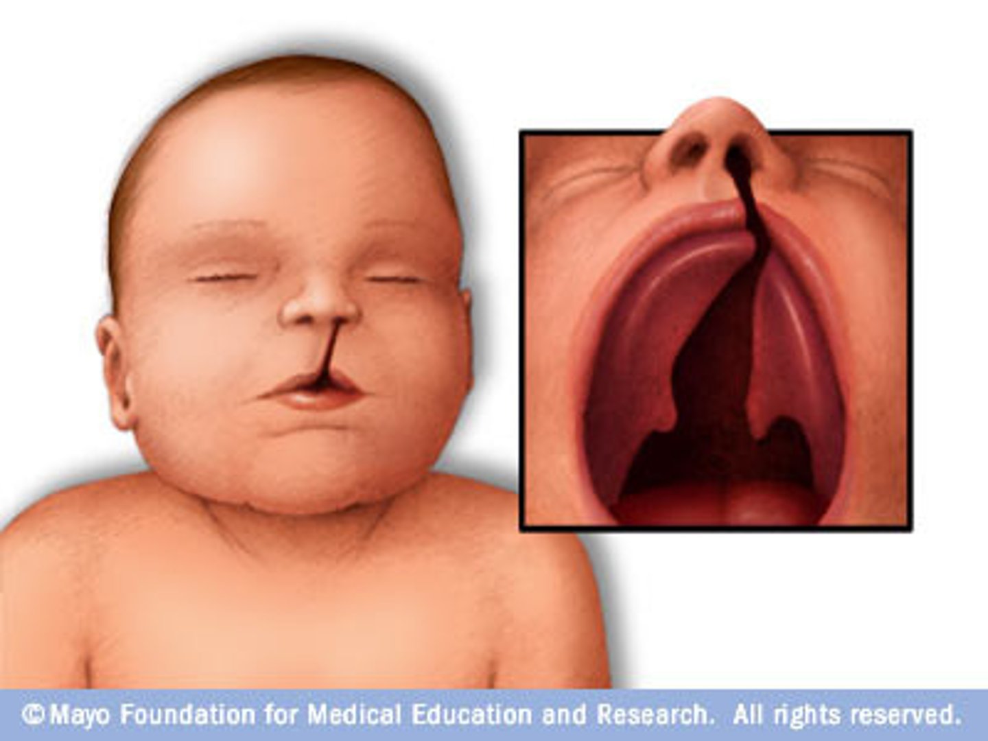 <p>cleft palate, bifid uvula</p>