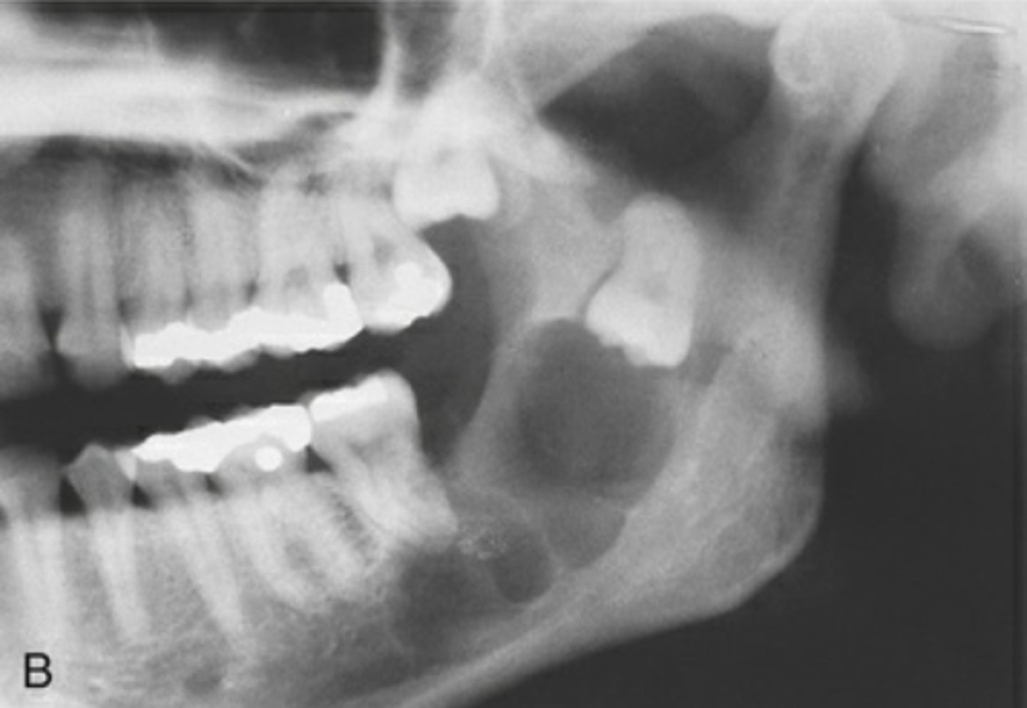 <p>benign, slow-growing but locally aggressive tumor</p>