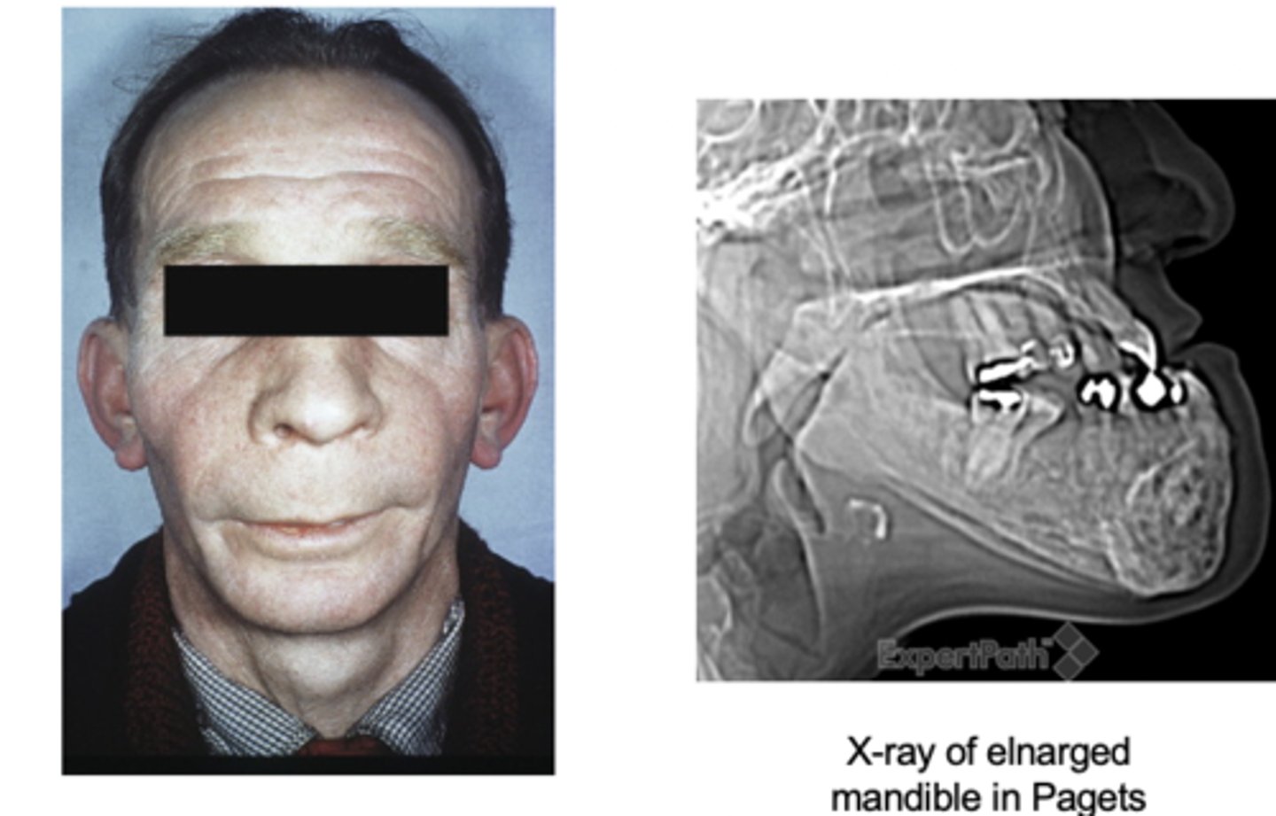 <p>- enlargement of craniofacial skeleton (may produce leontiasis ossea (lion face))</p>
