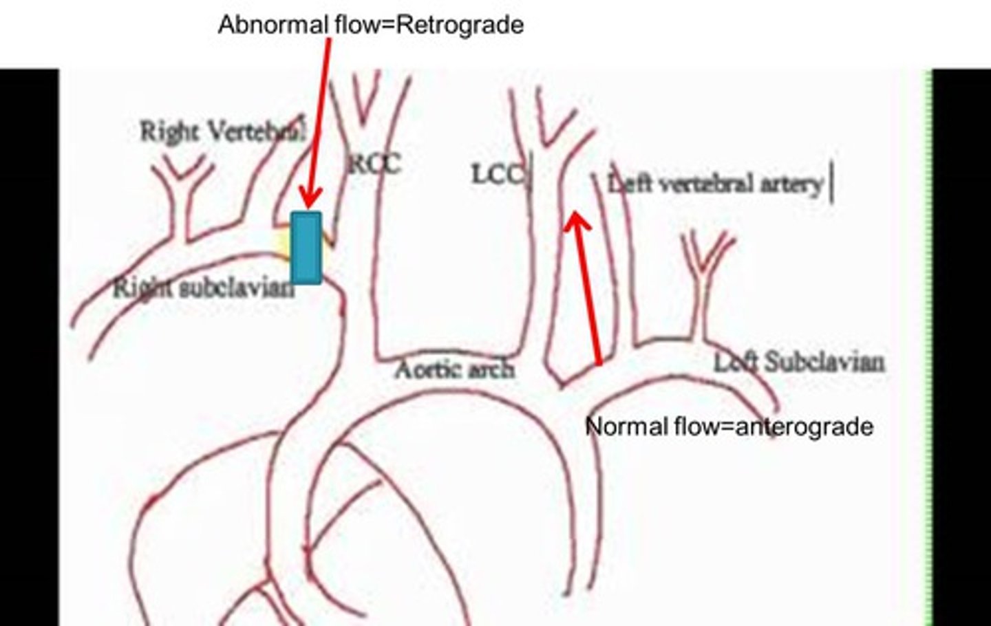 <p>Causes someone to pass out when they raise their right arm above their head</p><p>Occurs due to retrograde flow in the vertebral artery</p><p>occurs when the subclavian artery is occluded - between the right common carotid and vertebral artery - , and blood flow is diminished, or obstructed, to the head and upper extremities.</p>