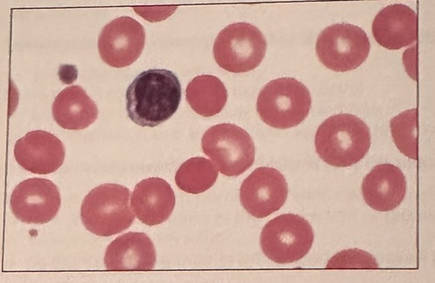 <p>b. nonmegaloblastic, macrocytic</p><p>nonmegaloblastic macrocytic anemias are characterized by erythrocytes that are round and macrocytic. This is in contrast to megaloblastic anemias in which macro-ovalocytes are present.</p>
