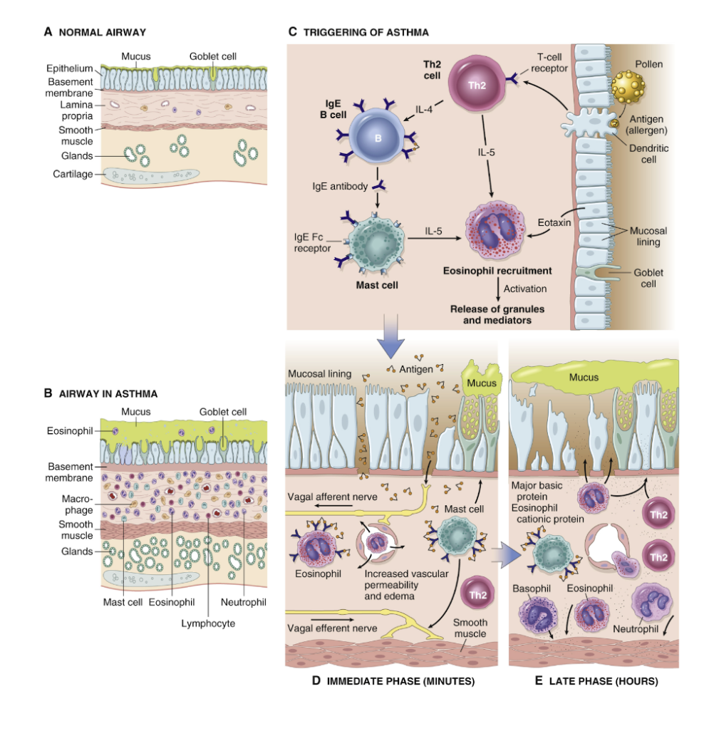 <p>Inflammationen medieras av Th2-celler och kommer att leda till produktion av IgE. Cytokiner såsom IL3, IL5 och IL13 medierar inflammation tillsamans med eosinofiler, mastceller, neutrofiler och basofiler. </p><p>Exponering för antigen leder till aktivering av mastceller och <strong>vagal aktivering</strong> → vasokonstriktion av bronker (bronkospasm) via M<sub>3</sub>-receptorer och ökad produktion av slem. Kärlen får ökad vaskulär permabilitet → mer eosinofiler rekryteras.</p><p>Skadorna är ofta reversibla med behandling men kan vara irreversibla vid långvarig astma utan behandling.</p>