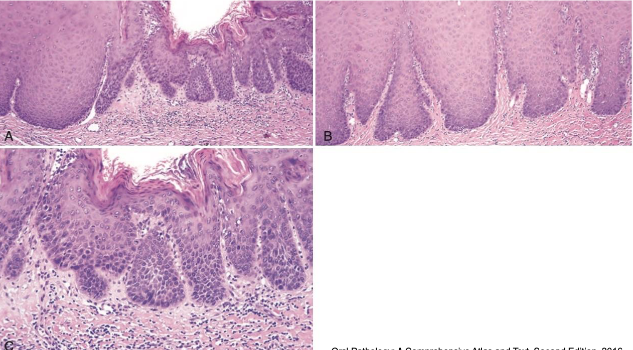 <p>which neoplastic white lesion:</p>
