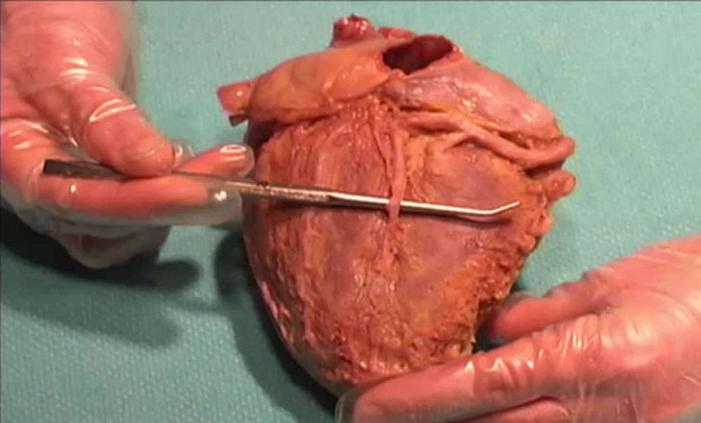 <p>What is this structure that is located above the metal pointer?</p><p>Posterior Interventricular Vein</p><p>Anterior Interventricular Vein</p><p>Posterior Interventricular Artery</p><p>Anterior Interventricular Artery</p>