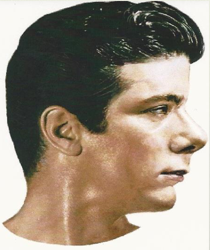 <p><span>Protruding forehead; Receding Chin</span></p>