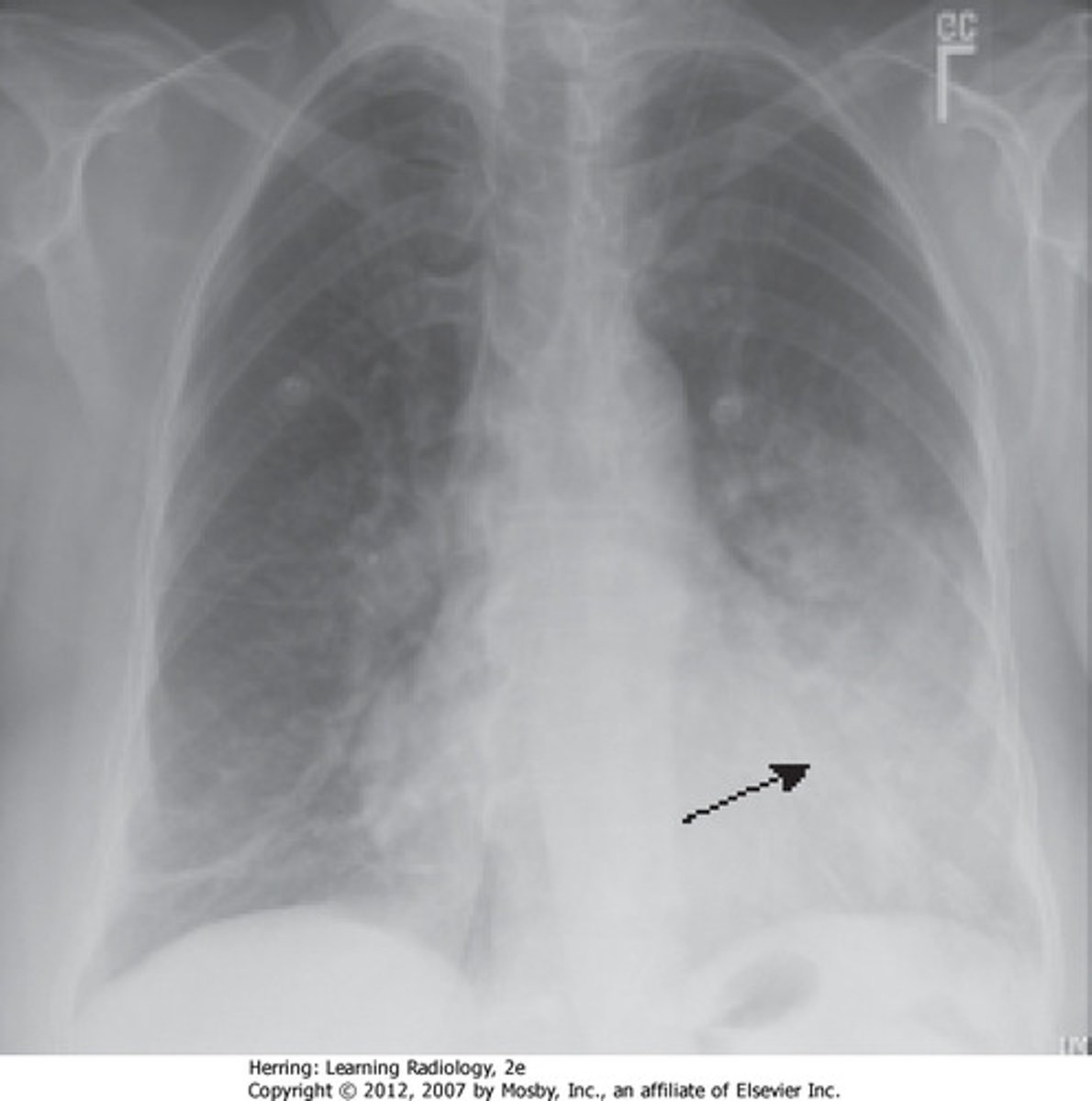 <p>Apex side</p><p>boundary</p>