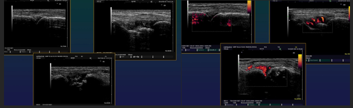 <ul><li><p>Small fluid effusion of joints</p></li><li><p>Panus</p></li><li><p>Erosions</p></li><li><p>Rheumatoid nodules</p></li></ul><p></p>