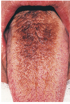 <ul><li><p>usual level of shedding of epithelium of filliform lingual papillae does not occur</p></li><li><p>thick layer of dead cells and keratin builds up on tongue surface which becomes extrinsically stained by tobacco, medicine, or chromogenic oral bacteria</p></li></ul><p></p>