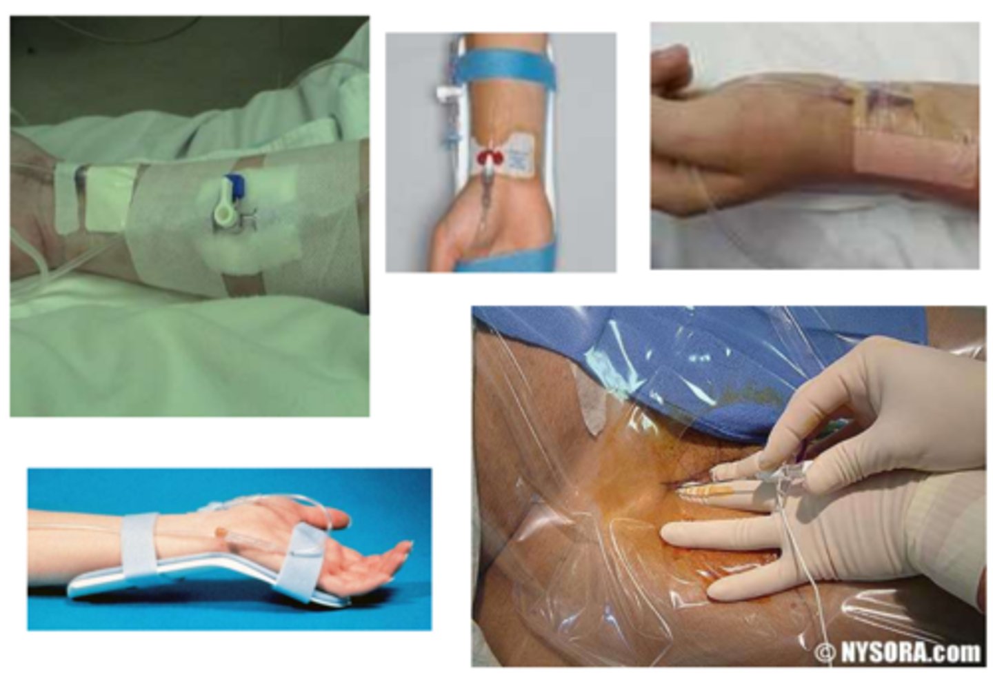 <p>Where are arterial lines placed?</p>