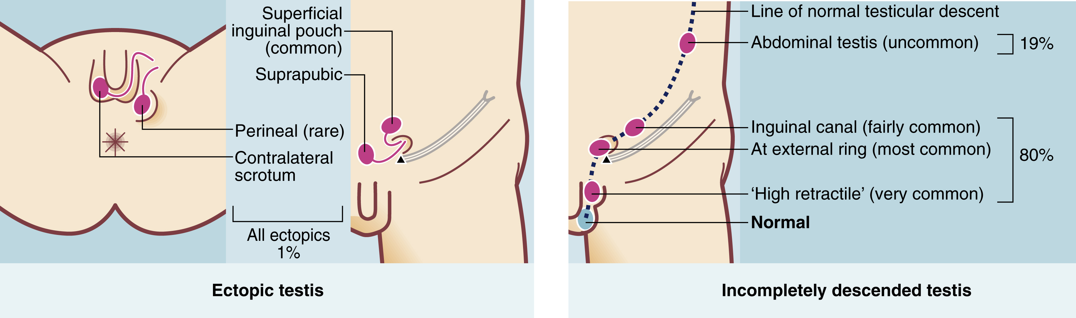 * occurs in 3% of full term boys (higher in premature)

  Full descent usually then occurs by 3-6 months (so when should it usually start by???) leaving 1.6% with maldescended testes and these ==__rarely descend later because androgen levels are highest in the first few months and then fall to very low levels until puberty__==
* 2 phases of descend:

  
  1. Migration from the gonadal ridge to the internal inguinal ring:
     * Depends on shortening of the gubernaculum, this is driven by mullerian inhibiting substance (not AMH?)
     * This phase is not androgen dependent
  2. Descent from the internal ring to the scrotum:
     * androgen dependent
     * 2nd phase maldescent can result from the testis being structurally abnormal rather than any abnormality caused by maldescent
* A maldescended testis may arrest anywhere on its path of descent. About 20% lie within the abdomen, but 80% lie in the groin area, in the inguinal canal or usually outside the external ring in the  superficial inguinal pouch or upper scrotum. In addition, 1% of maldescended testes are deflected and lie ectopically
* Risk of malignancy, sub fertility and torsion or trauma

  \+ cosmetic appearance and psychological impact of cryptorchidism
  * neoplasia:
    * carcinoma in situ is present in 2% of undescended testis → increases the risk by 10x compared to normal
    * If surgical correction is done early it may reduce the risk
    * Long term follow up after orchidopexy is good
  * Subfertility:
    * maldescended testis exhibit incomplete maturation of  seminiferous tubules → abnormal sperm quantity, form or motility

      This may be due to them being in the normal body temperature rather than the cooler (by 1 degree) temperature of the scrotum (recall that this is potentially important)
    * Earl orchidopexy helps maturation of the tubules and spermatogenesis, ideally between 6 and 12 months
    * Weirdly enough, those with ==__UNIlateral__== maldescent have more subfertility 
  * Torsion:
    * maldescended testis are abnormally mobile
    * Can occur at any age
    * Intrauterine or neonatal torsion occurs proximal to the reflection of the tunica vaginalis = extravaginal
* Boys should be examined regularly from birth till school age for this to allow timely surgery
* *There may be a fibrous band within the processus vaginalis preventing elongation of testicular vessels as the boy grows. The resulting ‘stationary’ testis appears to ascend, and can no longer be drawn comfortably into the scrotum.*
* *With a history of a missing testis, the chief point is whether the testis is palpable. If palpable at the scrotal neck, it should be gently manipulated into its correct position. If it then stays put, it is  retractile and needs no treatment, provided it becomes less retractile, as the boy grows. If the testis immediately retracts, it is maldescended and needs treatment*
* Optimum age for surgery is 6-12 months so fertility is not compromised
* Do we need to know how the surgery is actually done???