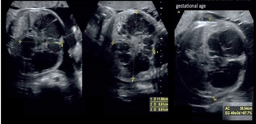 <p>a pt has scan for 26w. the head circumference, biparietal diameter, and femur length measure 25.5w. the abd circumference measure 28.5w</p><p>a) asymmetric IUGR</p><p>b) hepatic mesenchymal hamartoma</p><p>c) symmetric IUGR</p><p>d) hydrops </p>