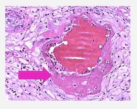 <ul><li><p>Necrosis associated with immune complex deposition involving blood vessels </p></li><li><p>Seen when complexes of antigens &amp; antibodies are deposited in walls of arteries </p></li><li><p>These complexes will activate complacent system &amp; neutrophilic activity </p></li><li><p>Immune complex deposits caused bright pink amorphous appearance </p></li></ul>