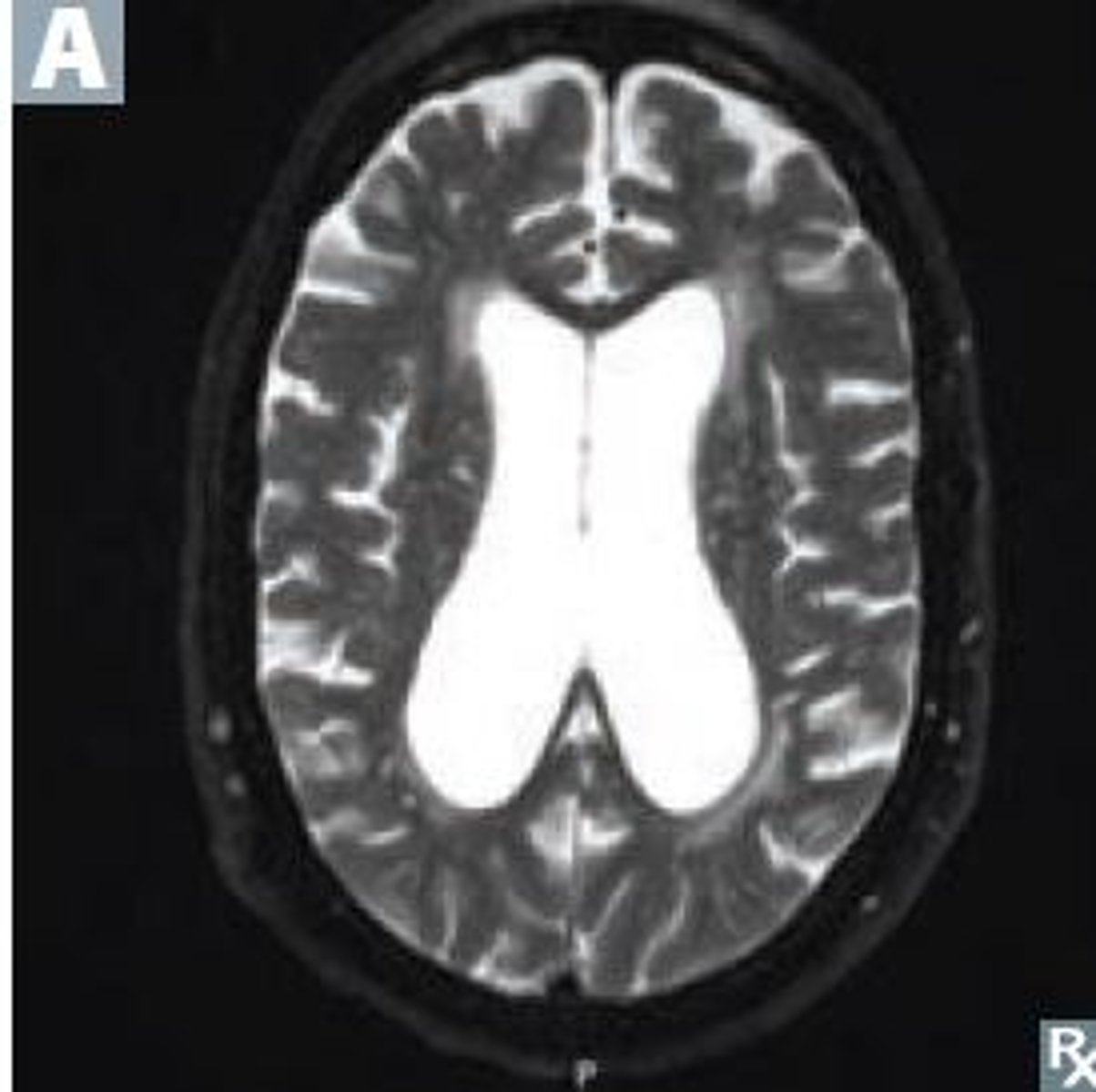 <p>Define Hydrocephalus Type:</p><p>-Decreased resorption of CSF at arachnoid granulations</p><p>*May see enlarged lateral, 3rd, 4th ventricles, with 4th pushing against cerebellum*</p>
