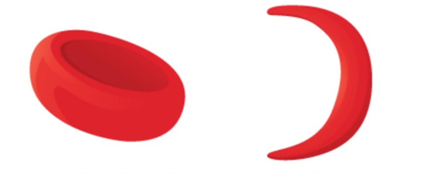 <p>when the red blood cells are very thin and shape in a crescent moon shape and cause lack of blood flow and oxygen for major organs; immunity to malaria</p>