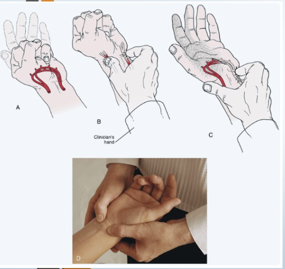 <p><span style="color: #NaNNaNNaN"><strong>• Tests for: </strong> Ulnar and radial artery</span><span style="color: #NaNNaNNaN"><br></span><span style="color: #NaNNaNNaN"><strong>• Positive sign: </strong>Unequal or slow (6 seconds) flushing in</span><span style="color: #NaNNaNNaN"><br></span><span style="color: #NaNNaNNaN">the hand when the blood flow is allowed to return</span><span style="color: #NaNNaNNaN"><br></span><span style="color: #NaNNaNNaN"><strong>• Method:</strong></span><span style="color: #NaNNaNNaN"><br></span><span style="color: #NaNNaNNaN">• Patient is asked to open and close the hand</span><span style="color: #NaNNaNNaN"><br></span><span style="color: #NaNNaNNaN">several times quickly</span><span style="color: #NaNNaNNaN"><br></span><span style="color: #NaNNaNNaN">• Then patient squeezes hand tightly</span><span style="color: #NaNNaNNaN"><br></span><span style="color: #NaNNaNNaN">• Therapist places thumb and index finger over</span><span style="color: #NaNNaNNaN"><br></span><span style="color: #NaNNaNNaN">radial and ulnar arteries compressing them</span><span style="color: #NaNNaNNaN"><br></span><span style="color: #NaNNaNNaN">• Patient opens hand while therapist maintains</span><span style="color: #NaNNaNNaN"><br></span><span style="color: #NaNNaNNaN">pressure</span><span style="color: #NaNNaNNaN"><br></span><span style="color: #NaNNaNNaN">• Then remove pressure from one artery and</span><span style="color: #NaNNaNNaN"><br></span><span style="color: #NaNNaNNaN">watch for flushing</span><span style="color: #NaNNaNNaN"><br></span><span style="color: #NaNNaNNaN">• Repeat for other artery</span></p>