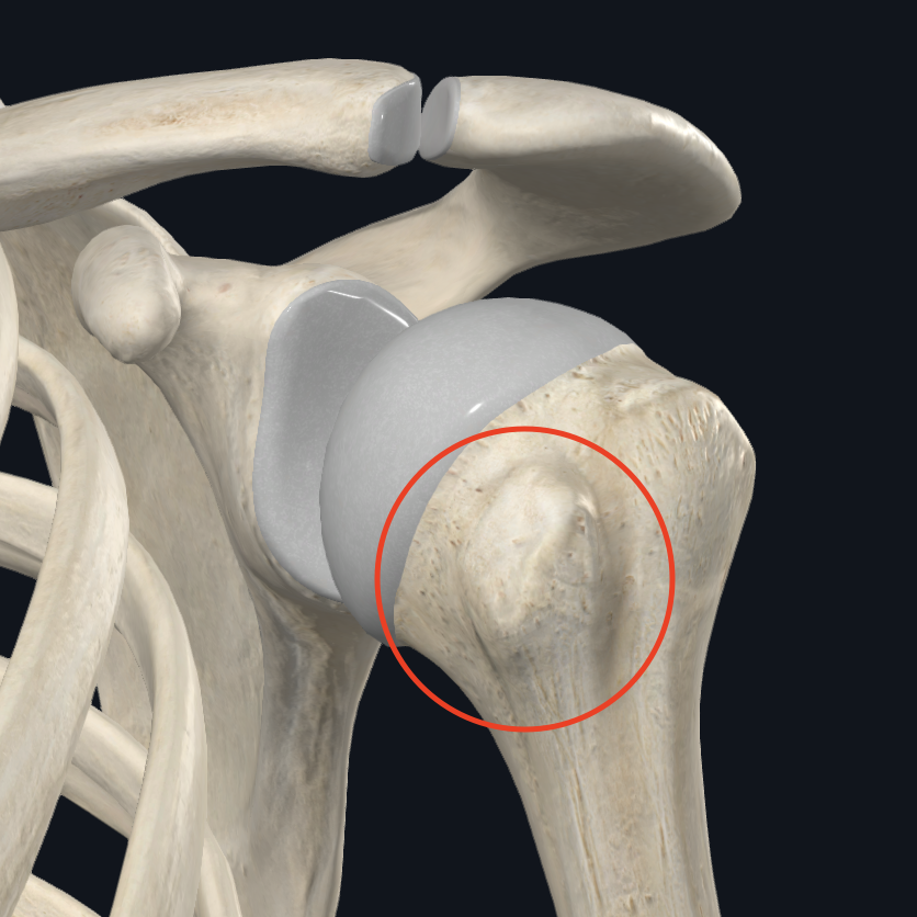 <p>Quel muscle se fixe sur le <strong><em>tuberculum minus humeri</em> </strong>(petit tubercule de l’humérus) ?</p>