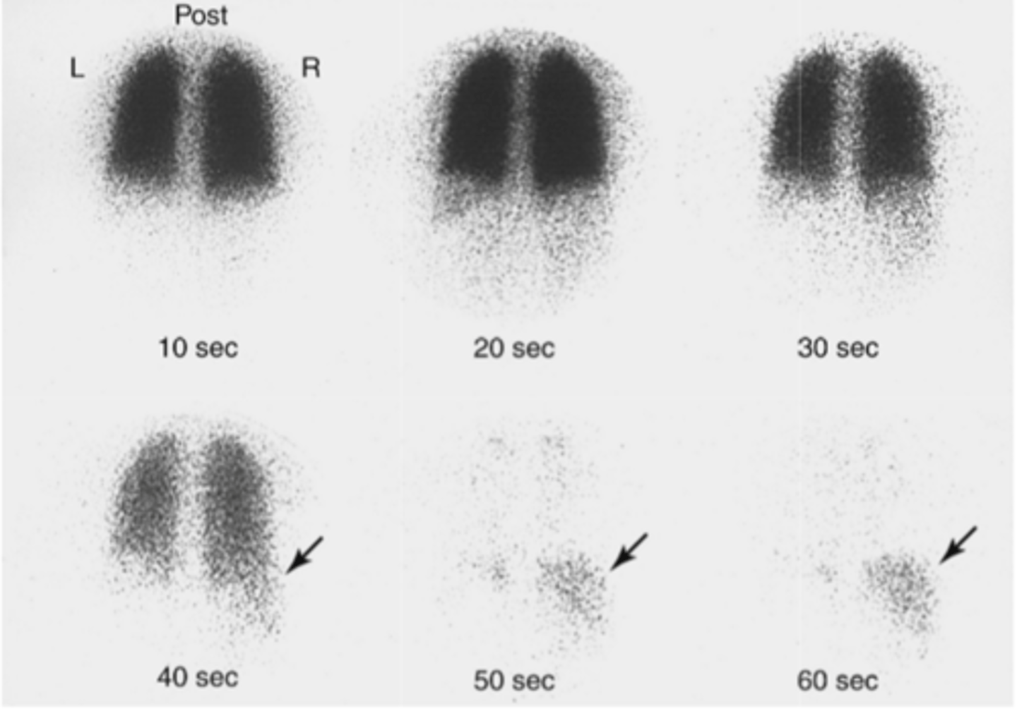 <p>when a drug or radioactive tracer is labelled with an unstable radionucleotide, the resulting radiation can be used to follow the tracer in the body</p><p>example: the use of flourine-18 on a biologically active molecule fludeoxyglucose ( FDG) which emits positrons. its introduced into the body and the emissions can be observed all around the body with varying concentrations</p><p>FDG is a good reflection of the glucose uptake by cells in the body</p>