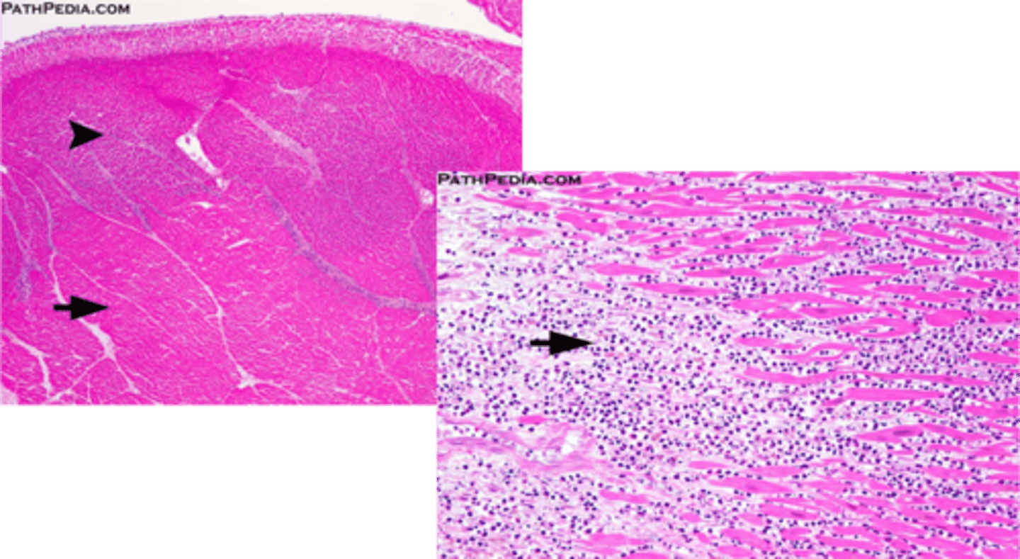 <p>Acute myocardial necrosis (2-3 days) is characterized by what microscopically?</p>