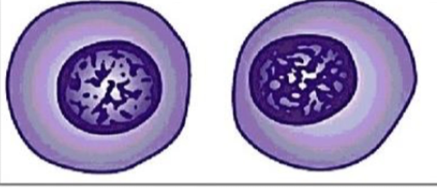<p>What term is used for the pattern that is coarser than normal, which may appear cordlike?</p>