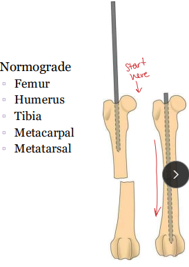 <ul><li><p><span style="background-color: transparent;"><strong><span>Insertion: </span></strong></span></p><ul><li><p><span style="background-color: transparent;"><strong><u><span>Retrograde</span></u></strong><span>: </span><u><span>fracture site → out epiphysis → repositioned → across fracture</span></u></span></p><ul><li><p><span style="background-color: transparent;"><strong><u><span>Ulna</span></u></strong><u><span>: retrograde; canal is narrow distally</span></u></span></p></li><li><p><span style="background-color: transparent;"><strong><u><span>Humerus</span></u></strong><u><span>: normograde OR retrograde; proximolateral → distomedial</span></u></span></p></li></ul></li><li><p><span style="background-color: transparent;"><strong><u><span>Normograd</span></u><span>e</span></strong><span>:</span><u><span> proximally → down medullary canal → across fracture</span></u></span></p><ul><li><p><span style="background-color: transparent;"><strong><u><span>Femur</span></u></strong><u><span>: normograde, ↓ sciatic/physis risk; start at trochanteric fossa</span></u></span></p></li><li><p><span style="background-color: transparent;"><strong><u><span>Tibia</span></u></strong><u><span>: normograde ONLY; start at tibial crest </span></u></span></p><ul><li><p><span style="background-color: transparent;"><u><span>medial, ~⅓ distance caudal to joint line, near patellar tendon</span></u></span></p></li></ul></li><li><p><span style="background-color: transparent;"><strong><u><span>Humerus</span></u></strong><u><span>: normograde OR retrograde; </span></u><span>start </span><u><span>proximolateral → </span></u><span>end </span><u><span>distomedial (avoid fossa)</span></u></span></p></li></ul></li></ul></li></ul><p></p>