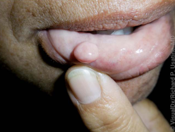 <p>bite fibroma characteristics</p>
