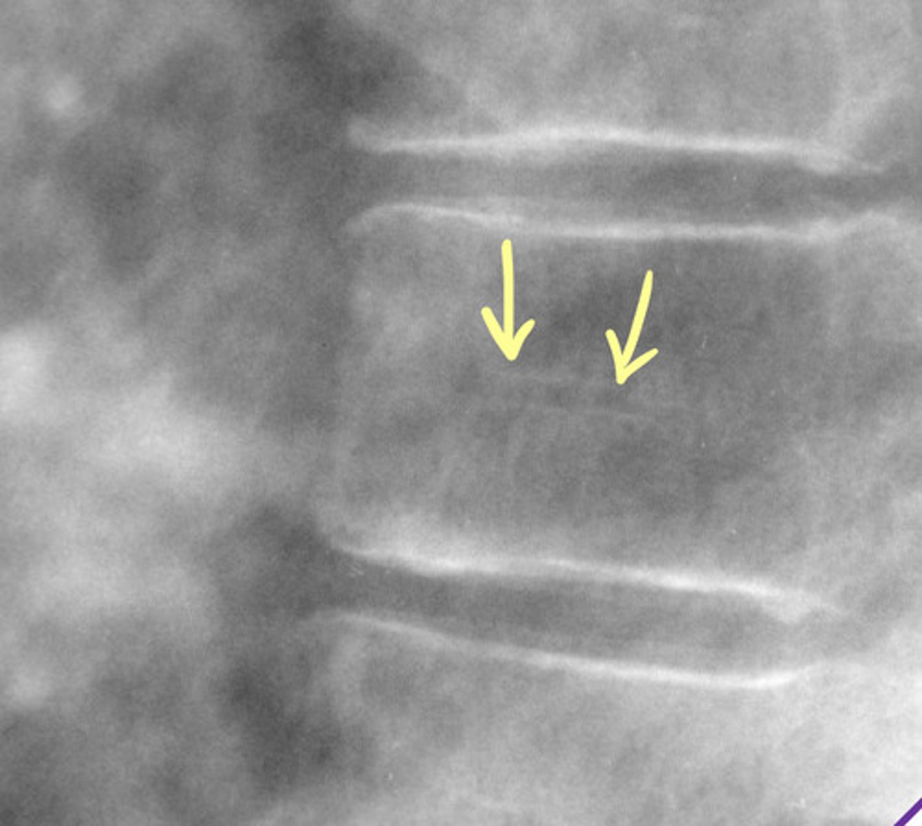 <p>Embryonic vascular channel = vertebral vascular foramina (Hahn Canal)</p><p>Do not mistake for a fracture</p><p>NO clinical significance</p>