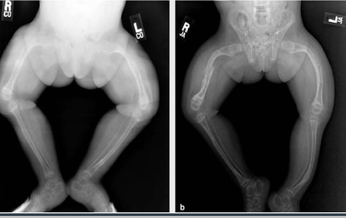 <ul><li><p>Osteopenia (low bone density)</p></li><li><p>Short stature/bowing of legs/pathologic fractures</p></li><li><p>Irregular skill (Wormian skull)</p></li><li><p>Hearing deficit</p></li></ul><p></p>