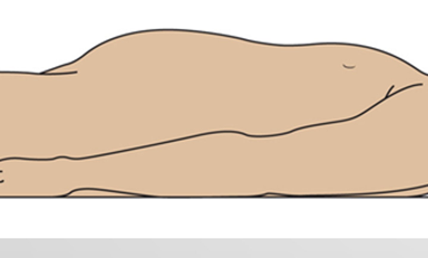 <p>a curved abdomen; common in young children or adults with poor muscle tone; normal if symmetrical; can be a sign of malnourishment because fluid leaks into peritoneal cavity due to low protein</p>