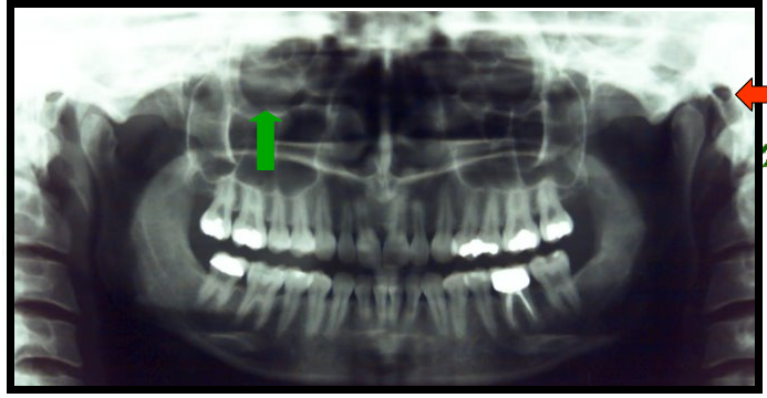 <ul><li><p><span>One appears as a round radiolucent compartment with radiopaque borders located superior to the maxillary sinuses.</span></p><ul><li><p><span>On most panoramic images only the inferior border of this is visible</span></p></li></ul></li><li><p><span>One appears as a round or ovoid radiolucency anterior and superior to the mastoid process.</span></p></li></ul><p></p>