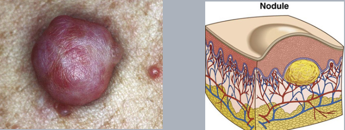 <p>nodule</p>