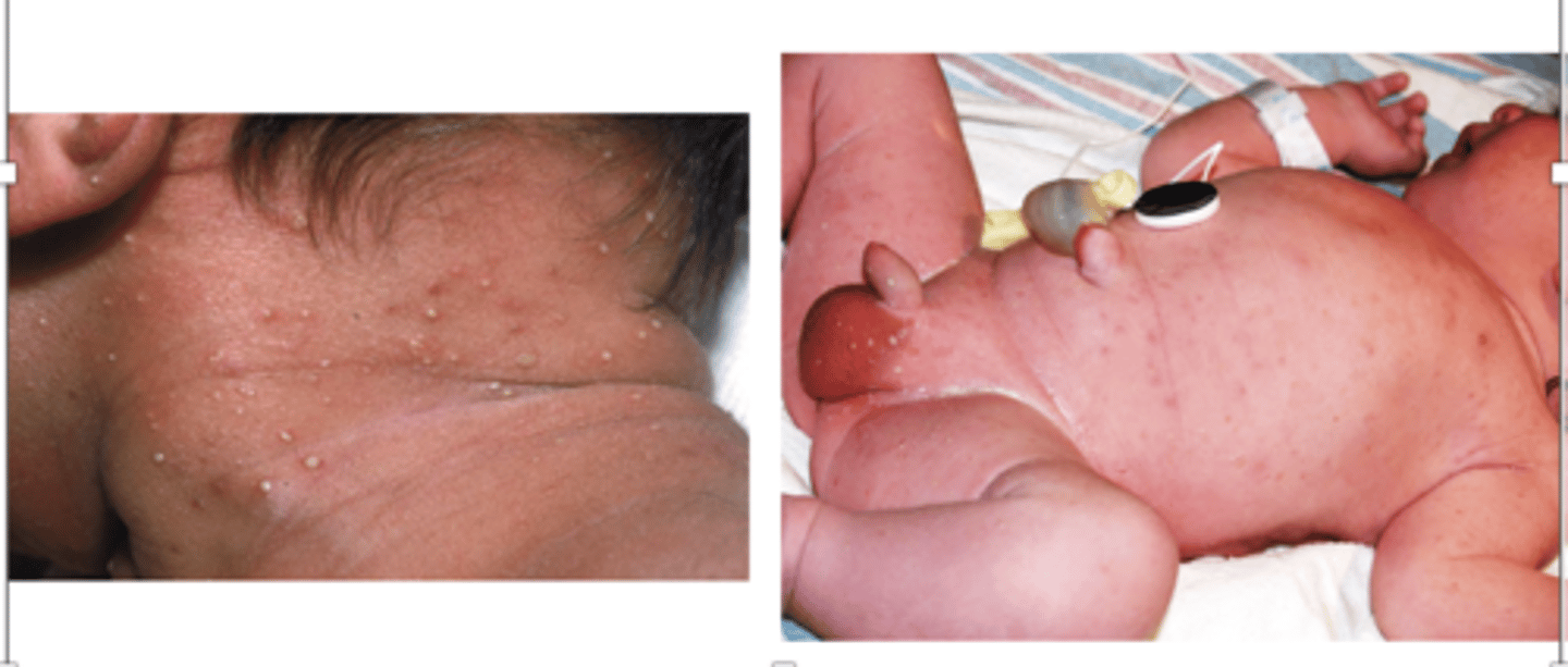 <p>- small pustules/vesicles present at birth</p><p>- leave pigmented macules upon resolution</p>