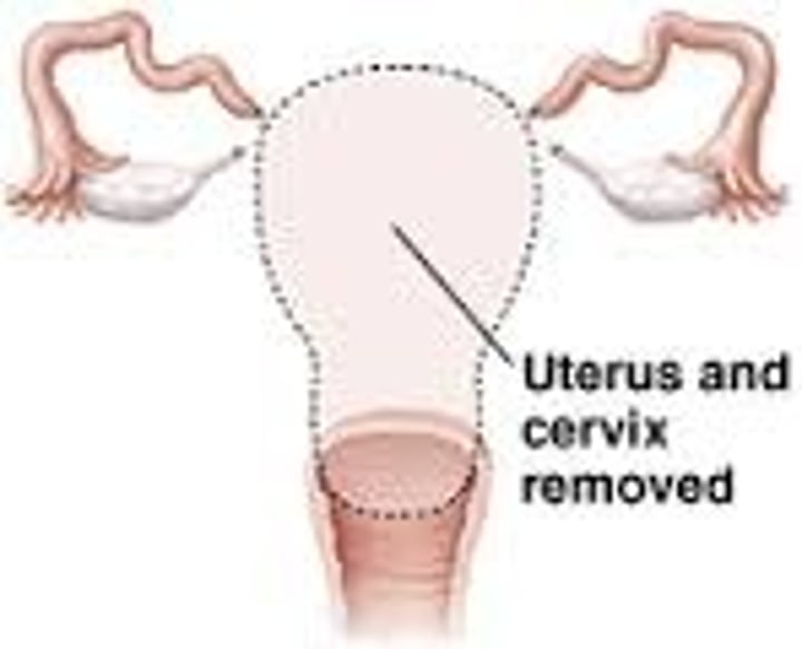 <p>removal of uterus</p>