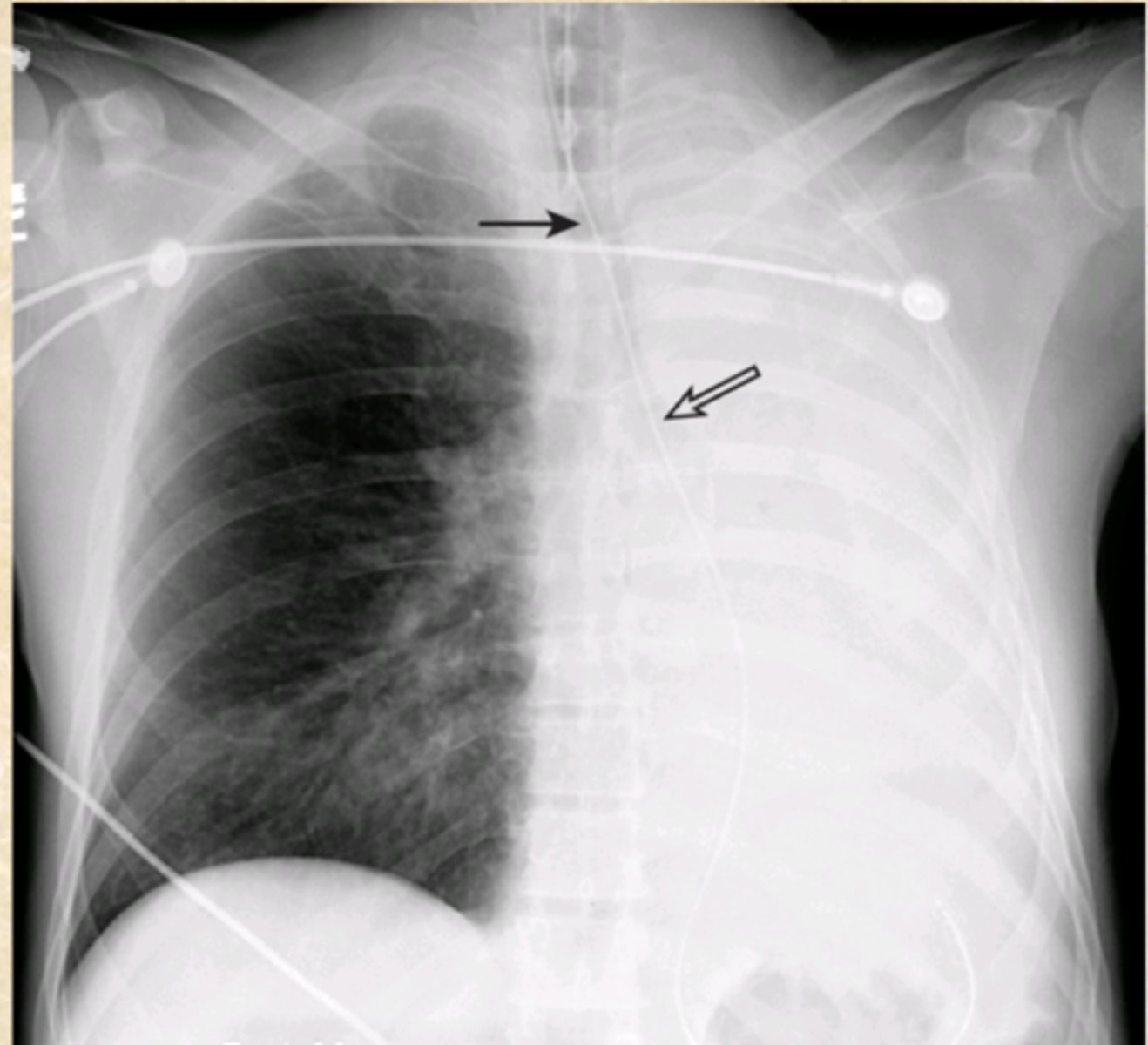 <p>What does this CXR show?</p><p>What is common cause of this condition?</p>