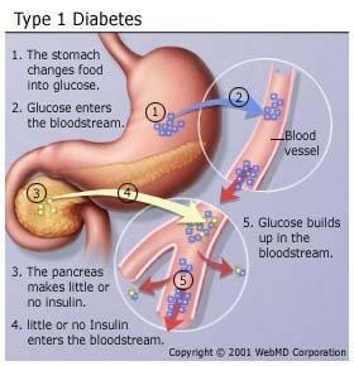 <p>An autoimmune disorder, in which the immune system attacks the insulin-producing cells of the pancreas (beta cells). Creates severe insulin deficiency.</p>