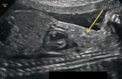 <ol><li><p>What is abnormal about this image?</p></li><li><p>This finding can be associated with what pathologies?</p></li></ol><p></p>