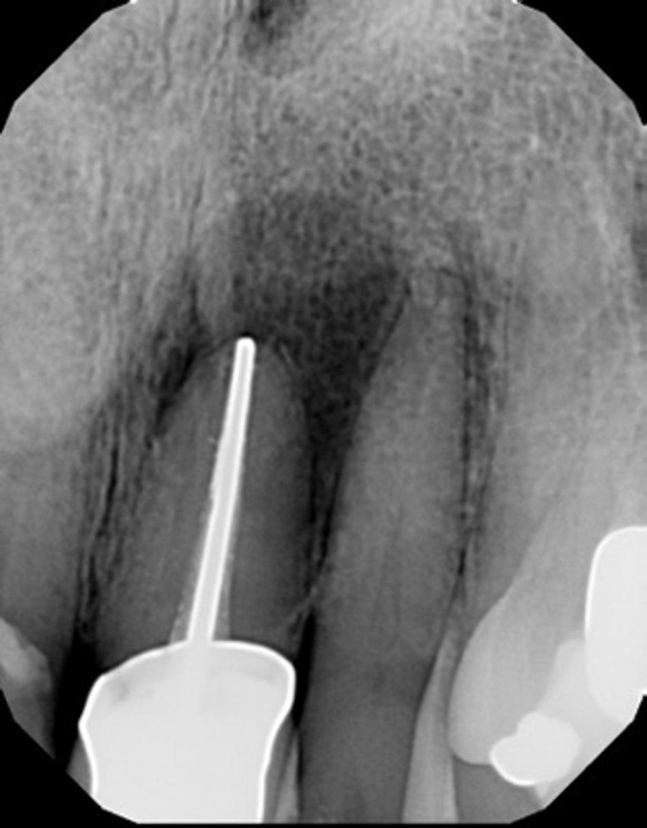 <p>What is the cause of this apical radiolucency?</p>