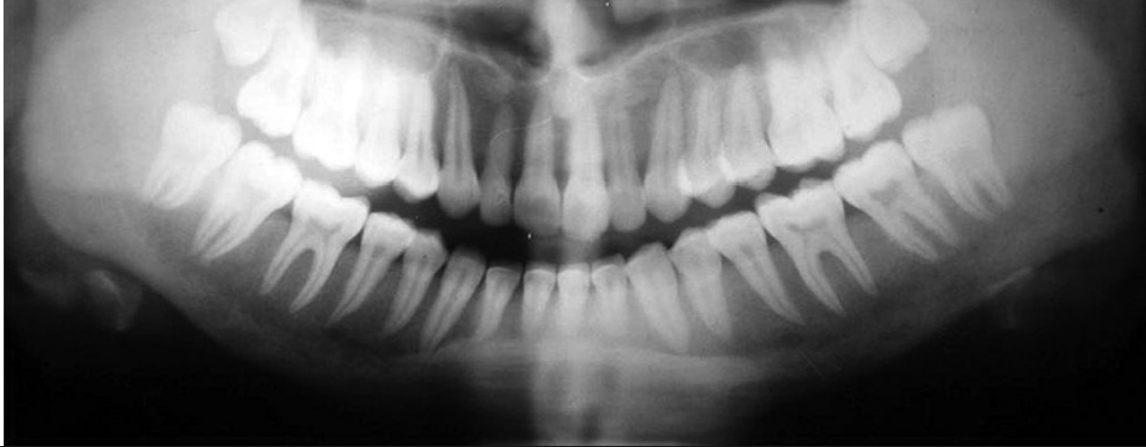 <ul><li><p>sometimes radiolucent lesions in the jaws, often multiple </p></li><li><p>loss of normal trabecular bone pattern </p></li><li><p>ground glass or frosted glass appearance </p></li><li><p>loss of lamina dura around the teeth </p></li></ul><p></p>