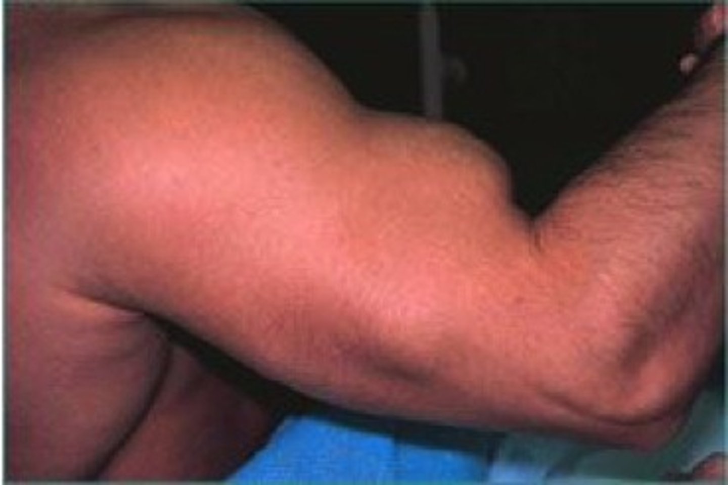 <p>Rupture of biceps long head tendon</p><p>Torn from attachment at supraglenoid tubercle of scapula</p><p>Detached muscle belly forms a ball</p><p>Occurs due to wear/tear</p>