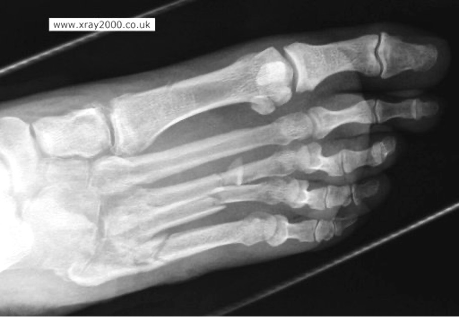 <p>fx of 2nd, 3rd, 4th, and/or 5th MT w/ lateral dislocation</p><p>MOI: foot caught in stirrup</p>