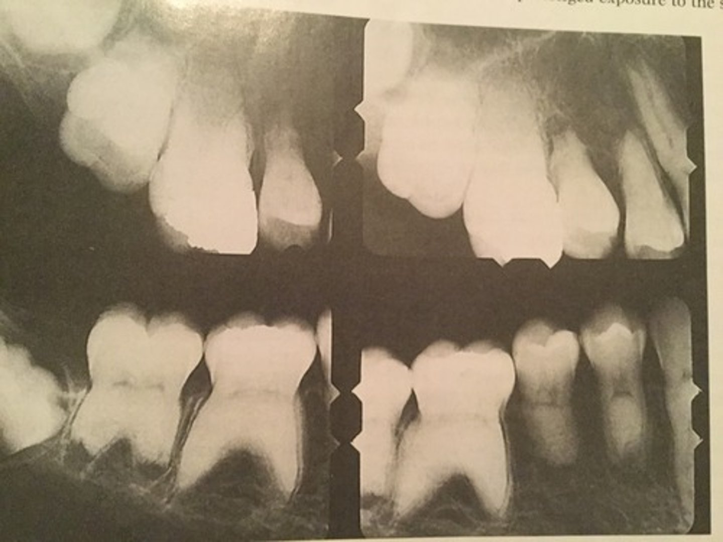<p>-shows blunted and short tooth roots, the few remaining pulp chambers have a half moon appearance</p><p>-teeth with normal crowns and abnormal roots</p><p>-the basic defects seems to lie in a disturbance in the hertwig epithelial root sheath</p>