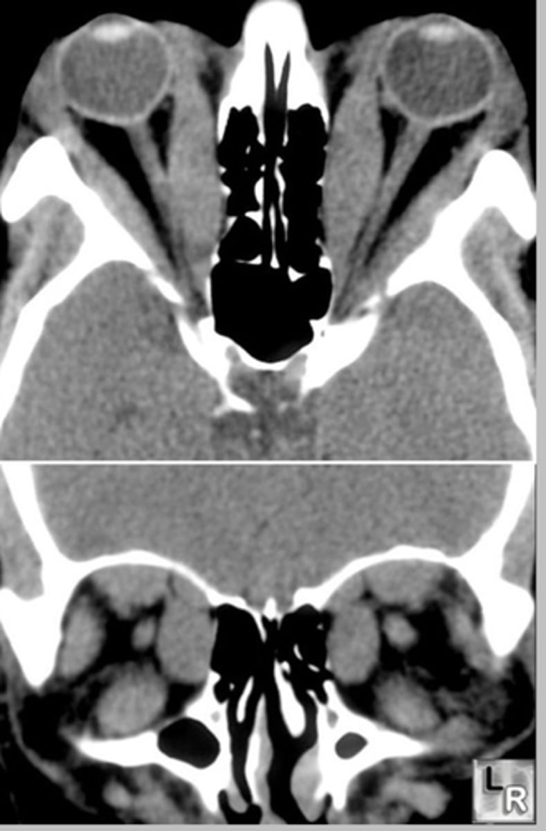 <p>only the muscle belly is enlarged.(coke bottle appearance of EOM)</p>