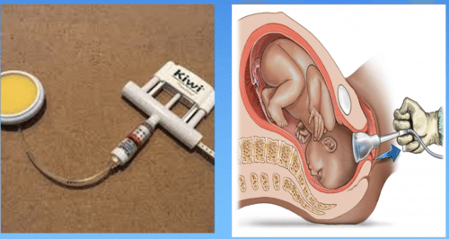 <p>suction cup on a cord</p>